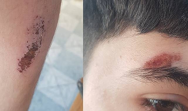 Urfa'da Sokak Köpeklerinden Kaçan Çocuk Düşerek Yaralandı